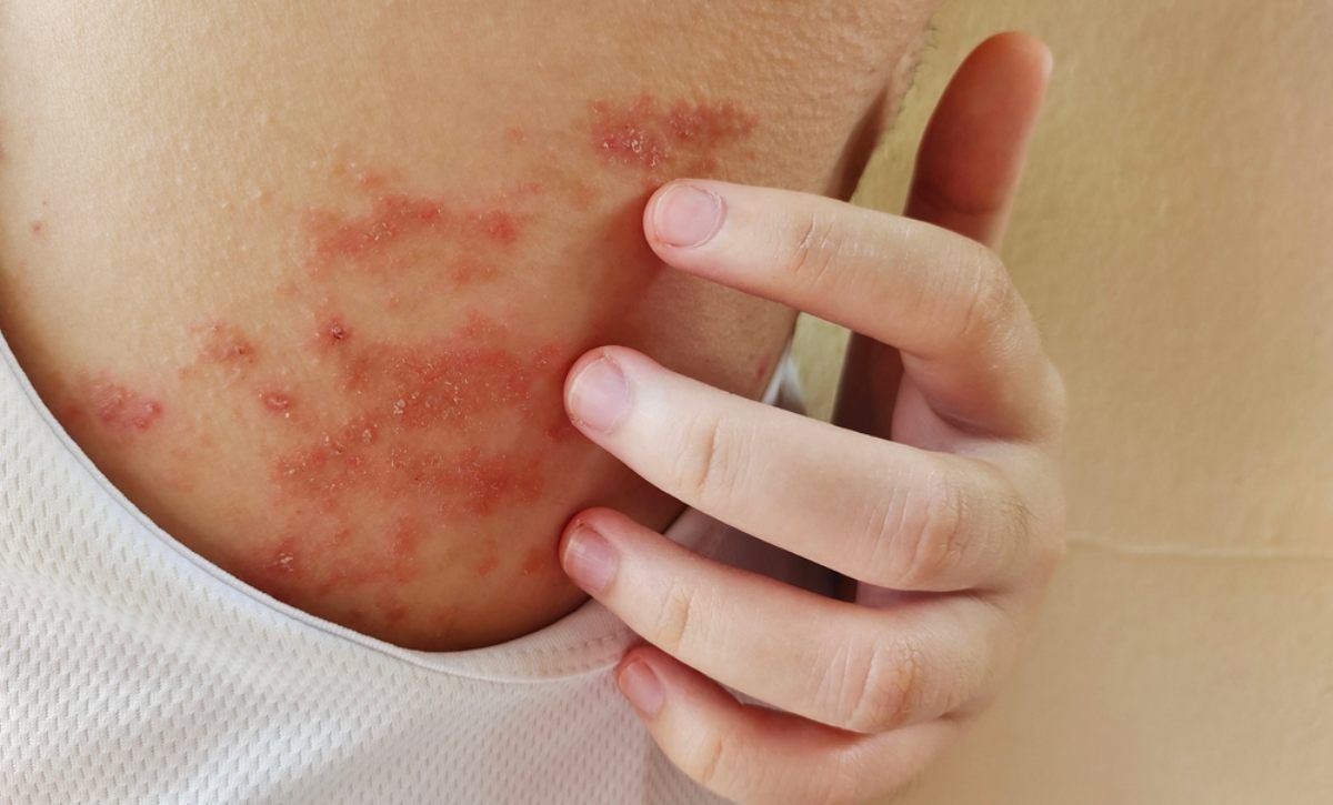 vết thương do cào gãi nhiều
