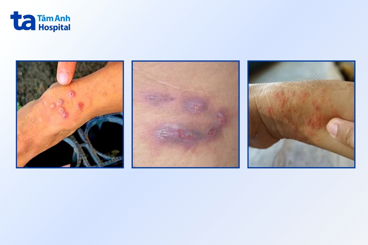 Vi khuẩn bệnh “sốt đất” xâm nhập qua vết thương hở có thể gây loét, mụn mủ hoặc áp xe da kèm sưng đau, rỉ dịch