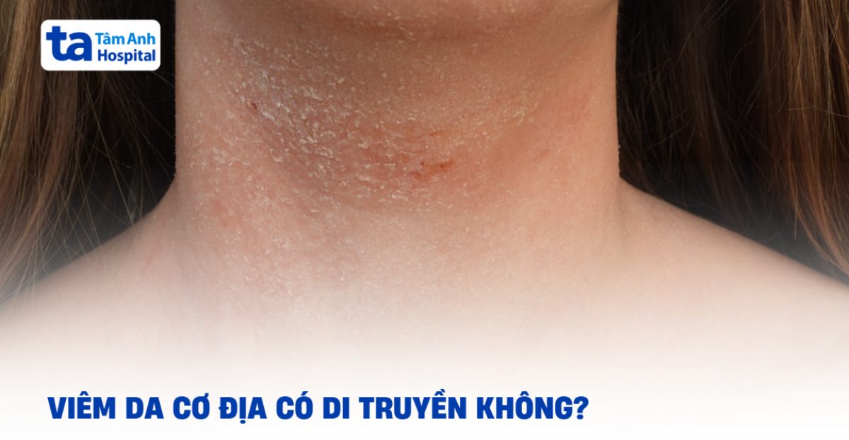 Giải đáp: Viêm da cơ địa có di truyền không?