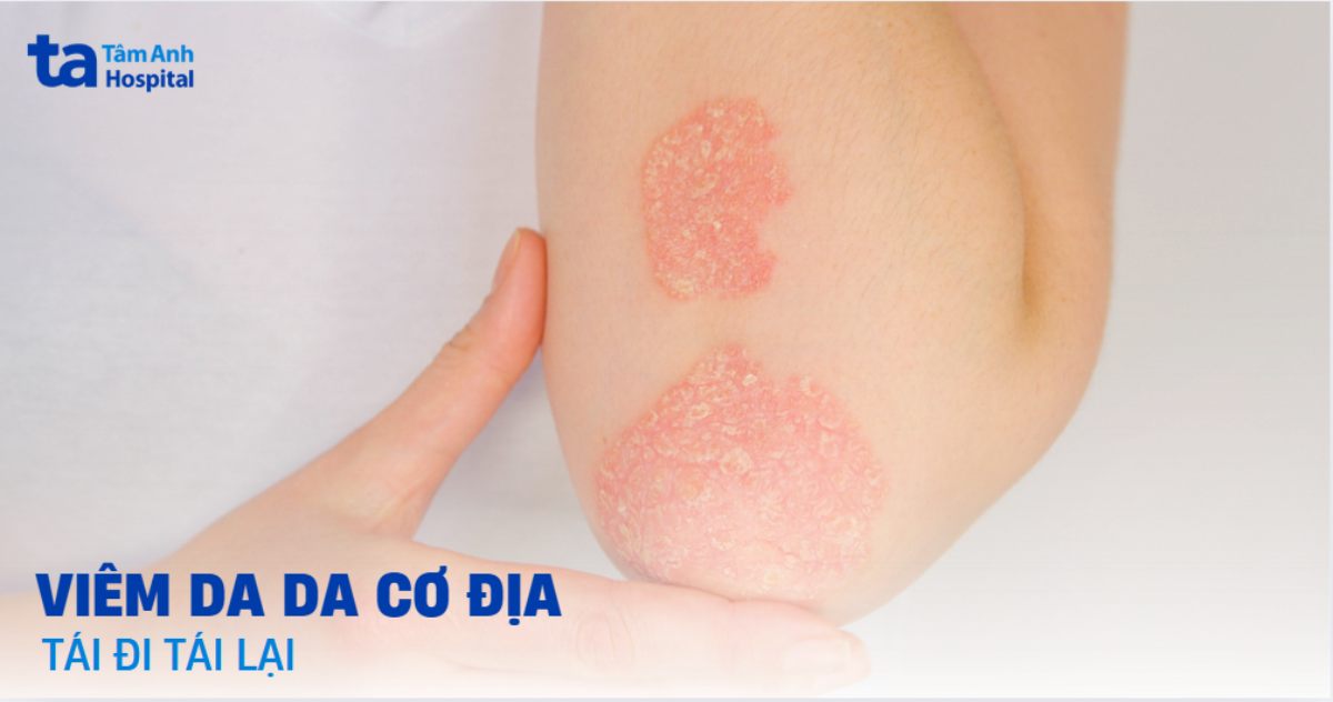 Lý do viêm da cơ địa tái đi tái lại nhiều lần