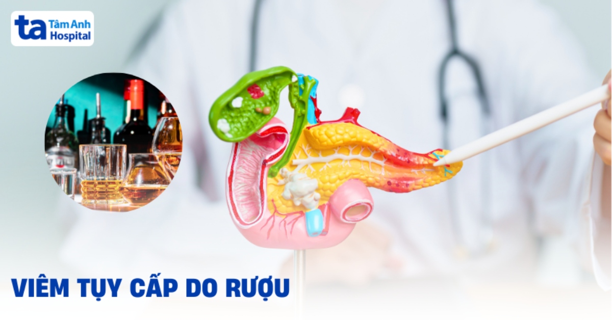 Phòng ngừa viêm tụy cấp do rượu: Cai rượu bia là giải pháp