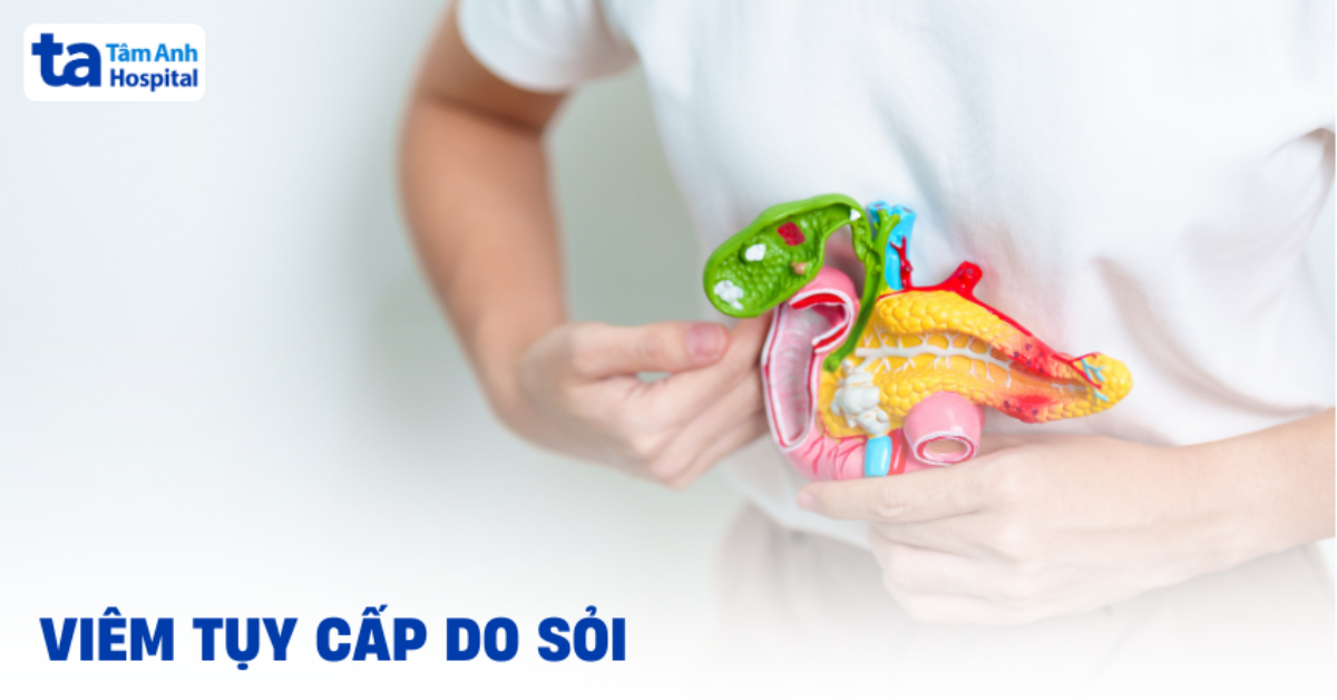 Viêm tụy cấp do sỏi mật – Cần làm gì ngay?