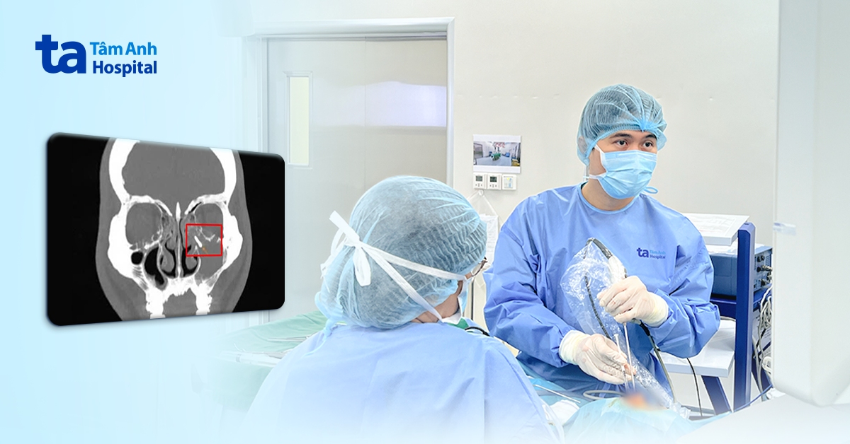 Vít niềng răng 2 cm ‘đi lạc’ vào xoang hàm