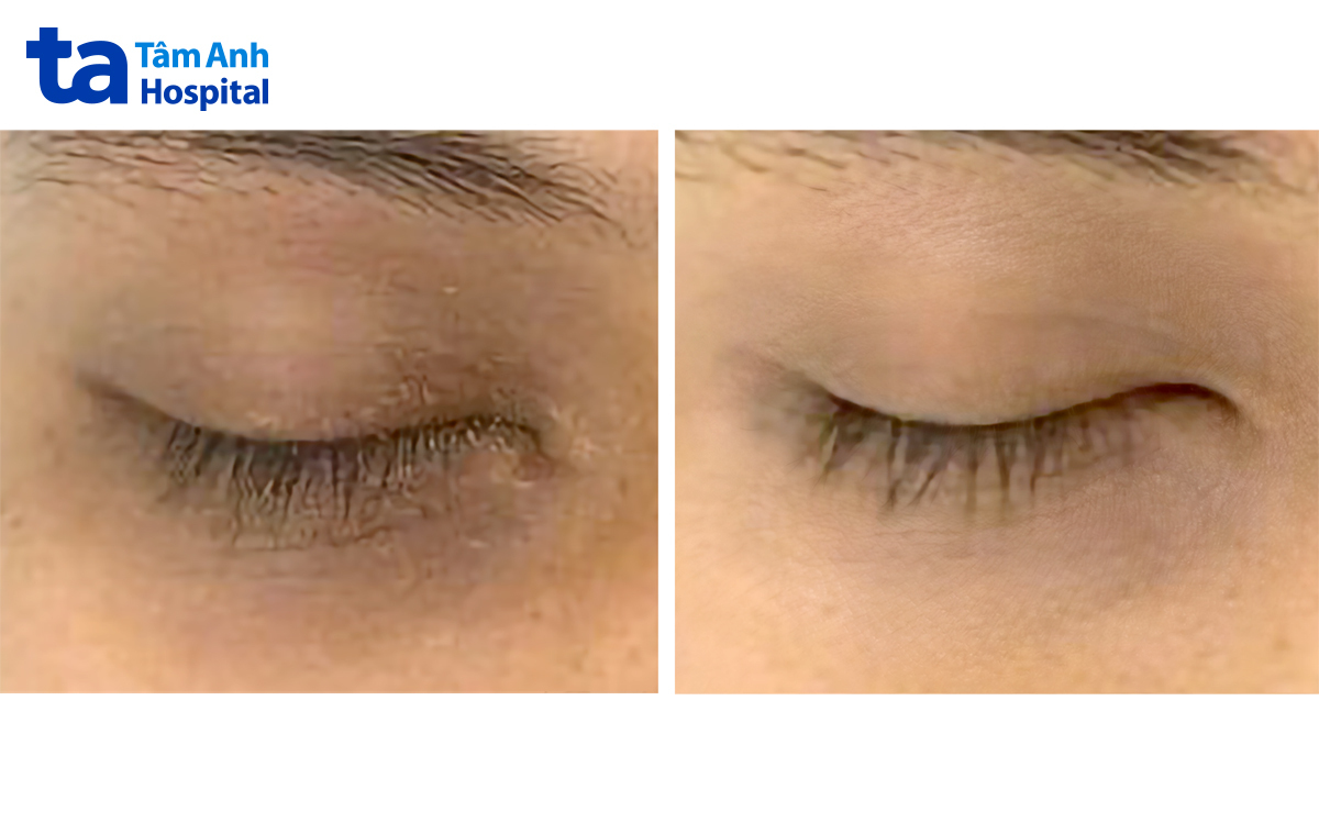 vùng da quanh mắt đã cải thiện bớt thâm
