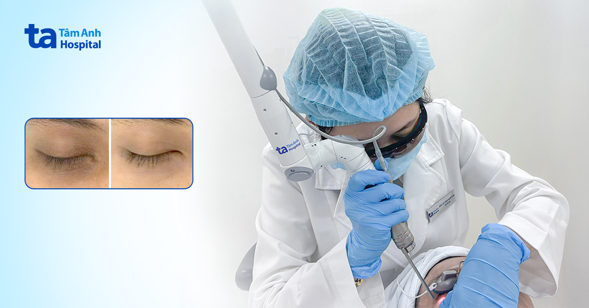 Xóa quầng thâm mắt “gấu trúc” bằng laser Pico Pro