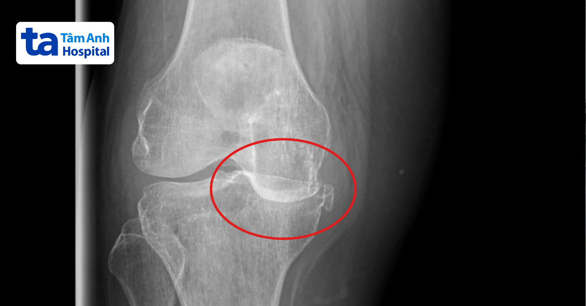 xquang cho thấy võ mâm chày trong