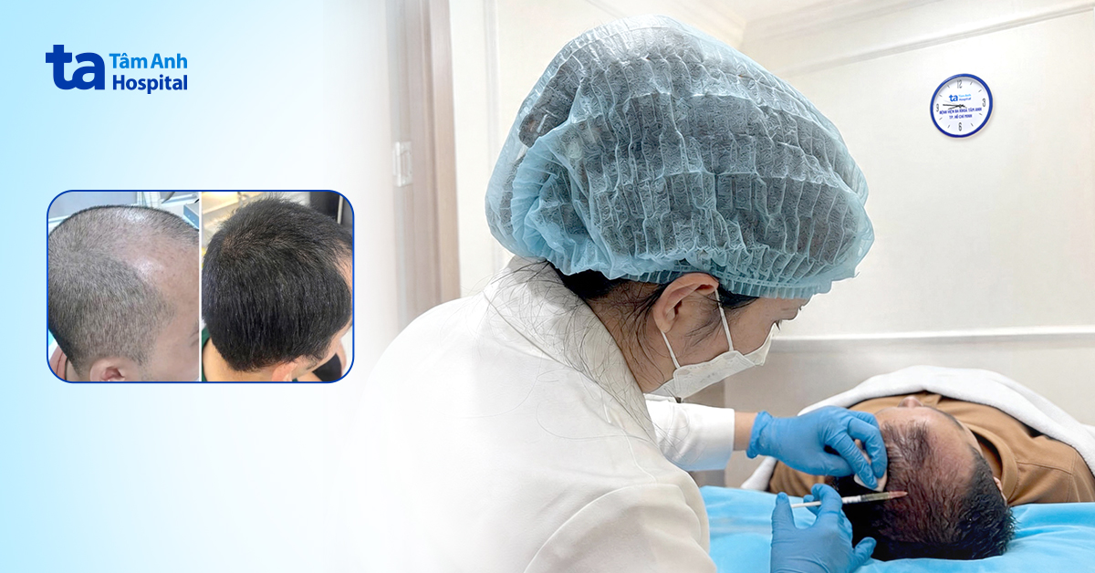 18 tuổi phải cạo trọc đầu vì hói sớm