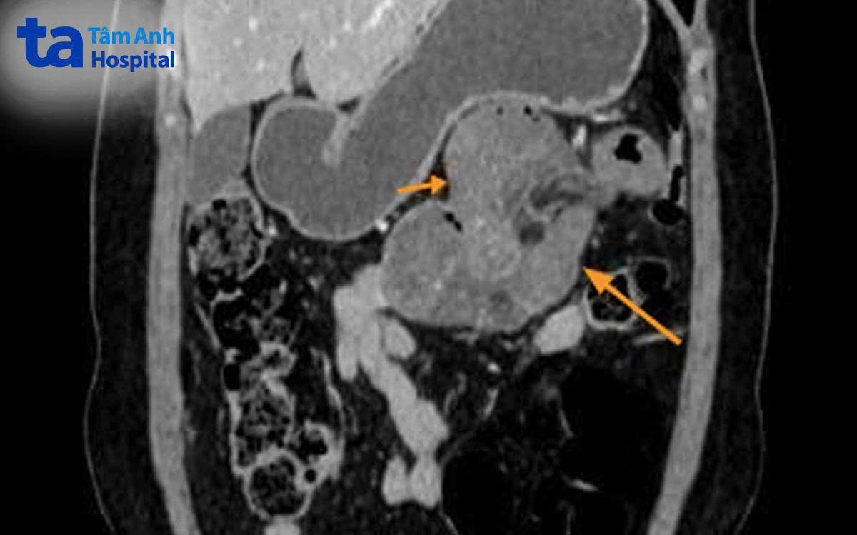 ảnh CT ruột non giãn lớn