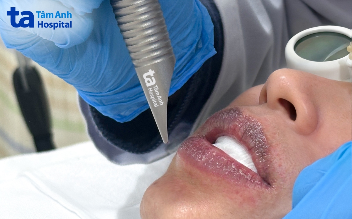 bác sĩ sử dụng laser 6d xung dài làm hồng môi tự nhiên cho chị phú