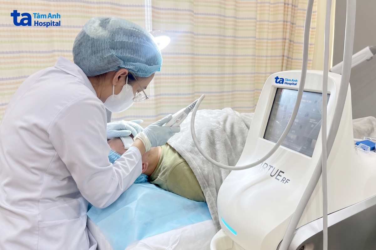 bác sĩ sử dụng vi kim RF điều trị sẹo mụn cho người bệnh