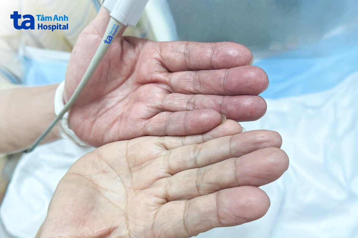 Bàn tay bên phải của bà Tú trắng bệch vì thiếu máu nuôi