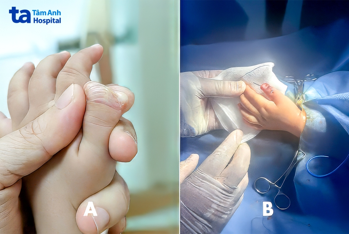 bàn tay trái của thư trước và sau mổ.