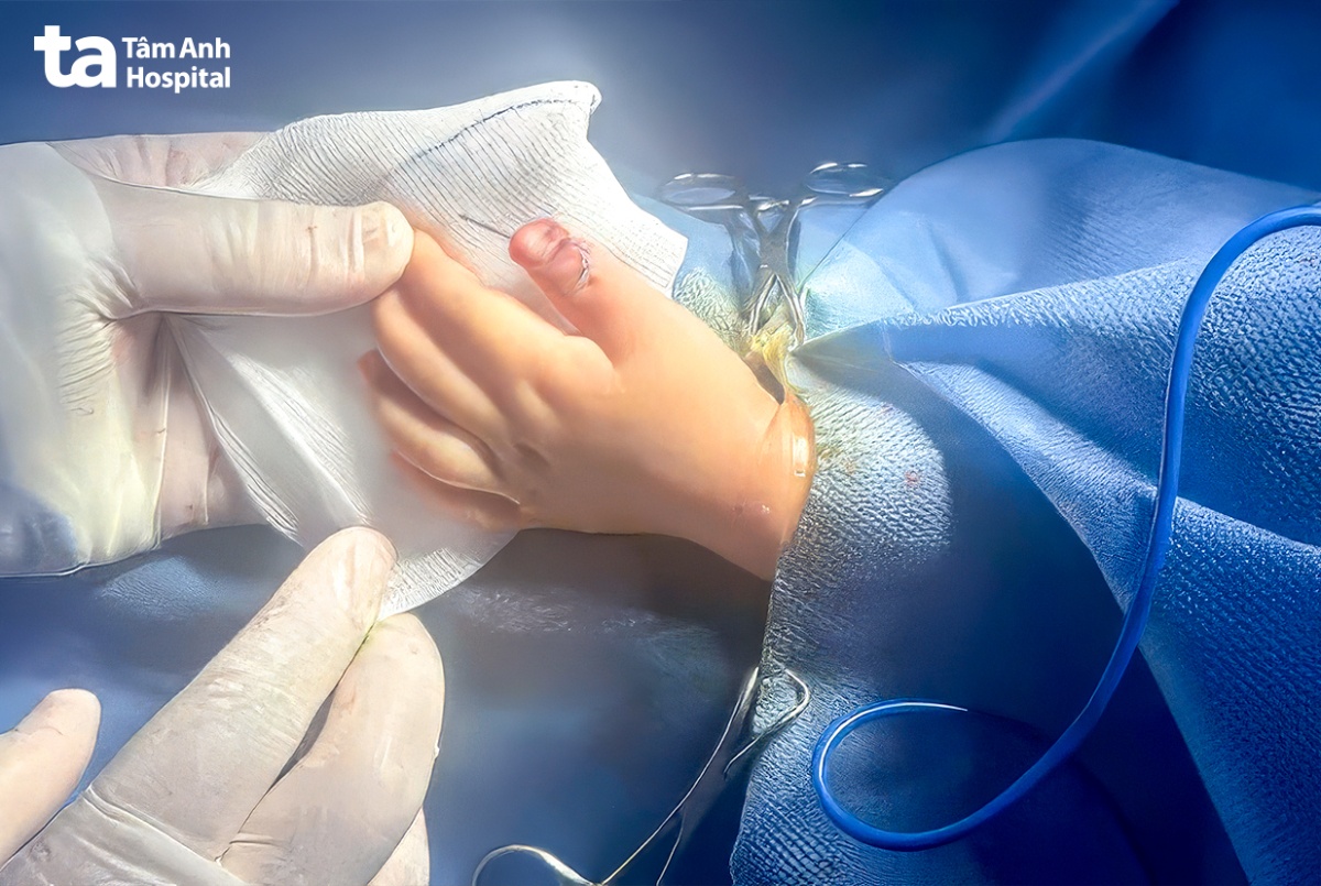 bàn tay trái của thư trước và sau mổ