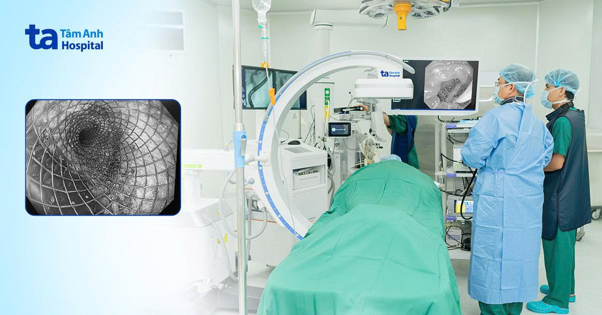 Từ Mỹ về Việt Nam đặt stent tái thông thực quản