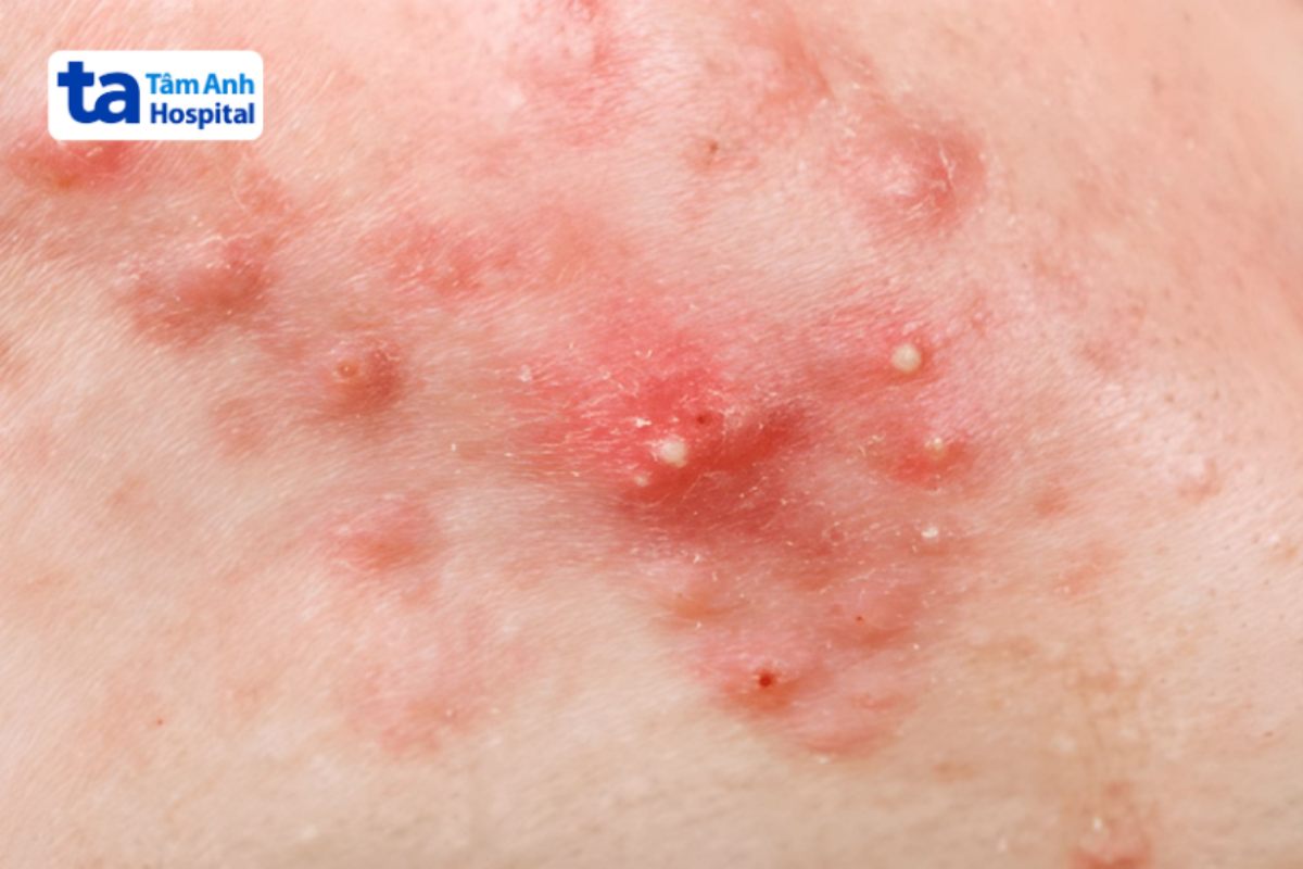 các nốt mụn viêm mủ