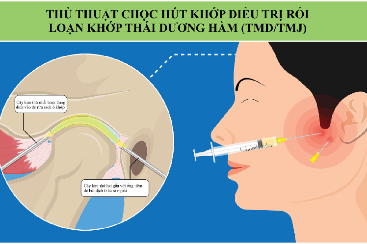 Chọc Hút Dịch Khớp Hàm