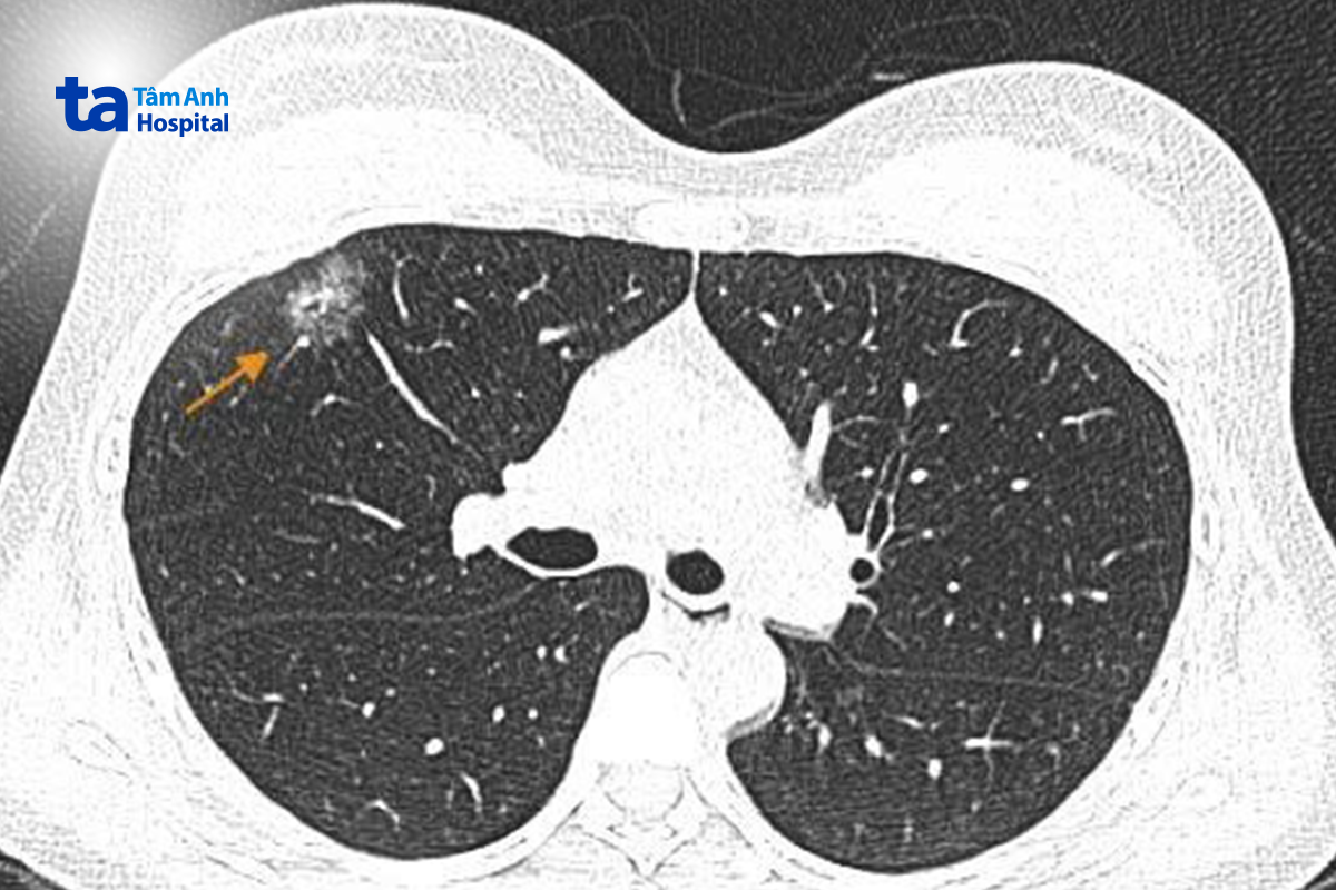 ct phổi liều thấp