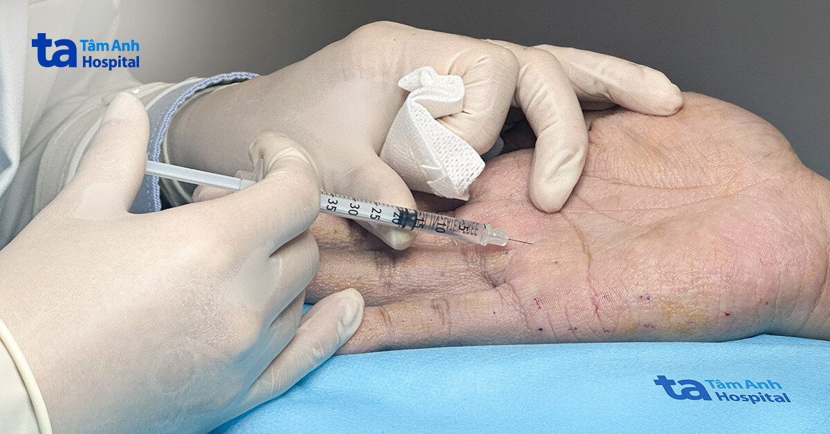 Giảm 70% mồ hôi tay sau 1 lần tiêm botox