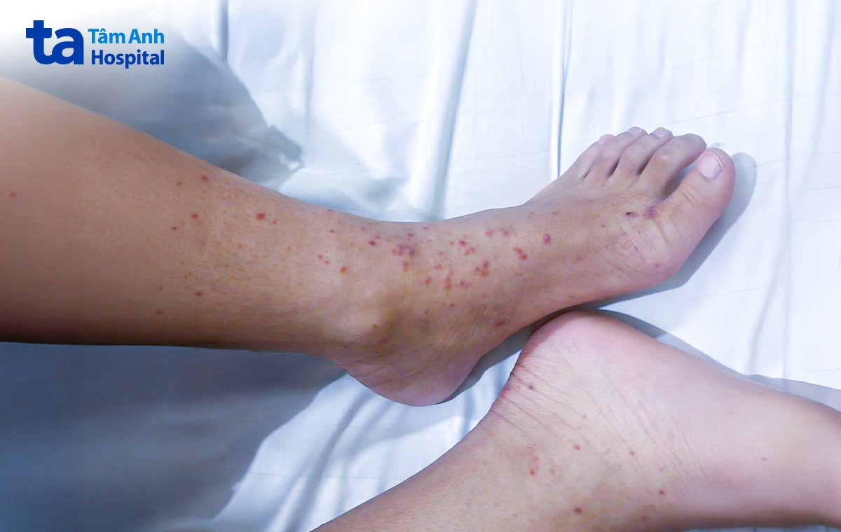 hai chân của minh xuất hiện dày đặc ban xuất huyết