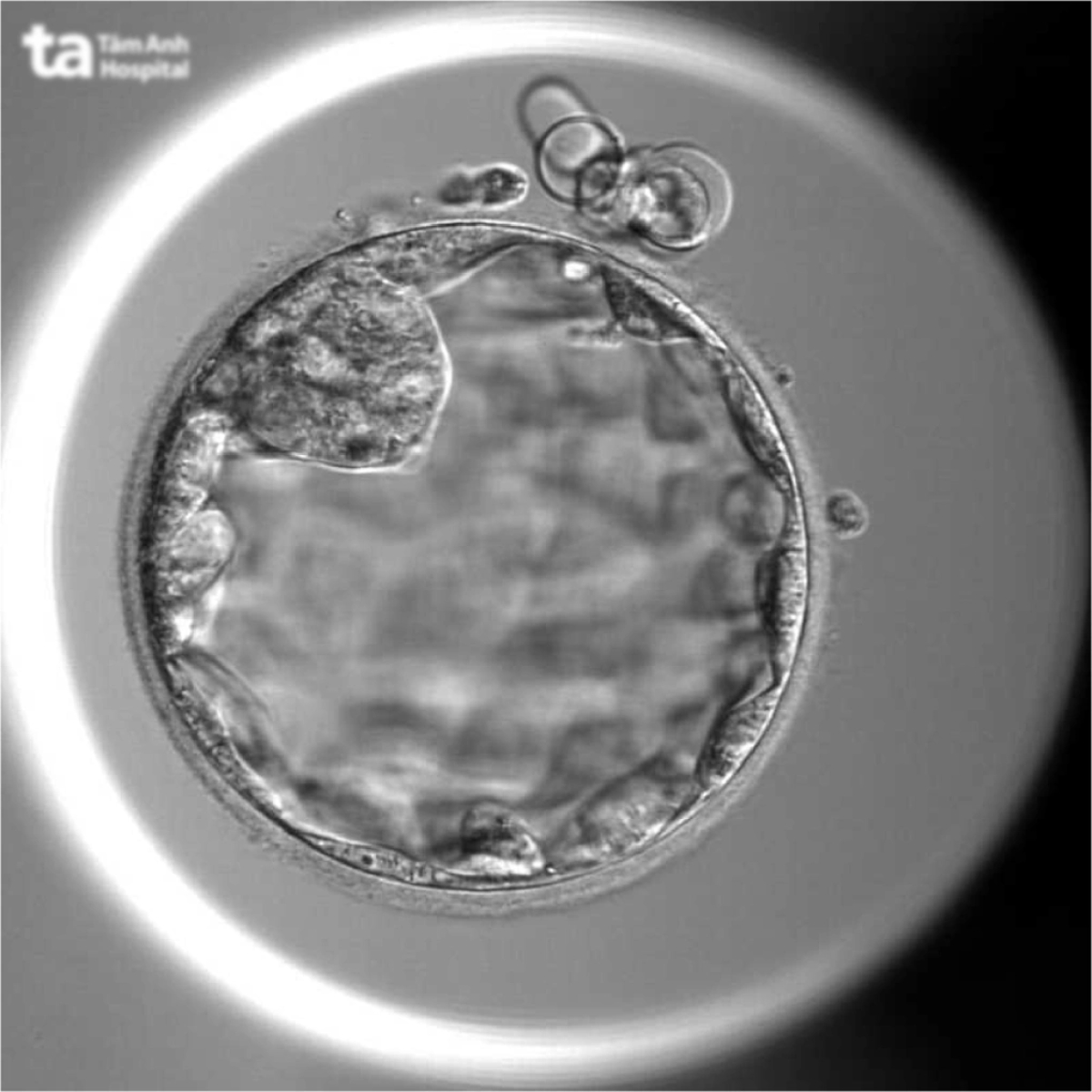 Hình ảnh phôi ngày 5 của chị Nguyệt được hệ thống camera ghi lại khi nuôi cấy tại IVF Tâm Anh