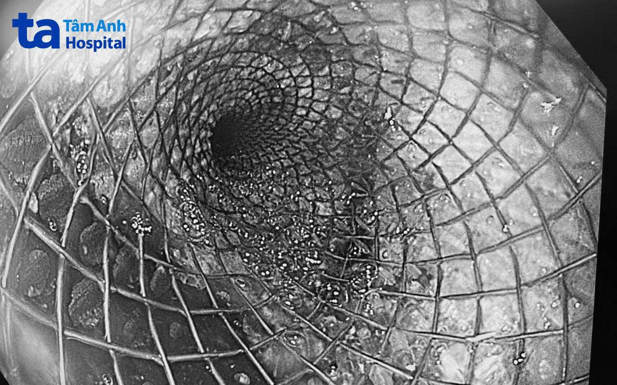 hình ảnh stent đặt vào thực quản