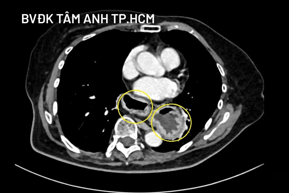 hình chụp mri khối lồng ruột