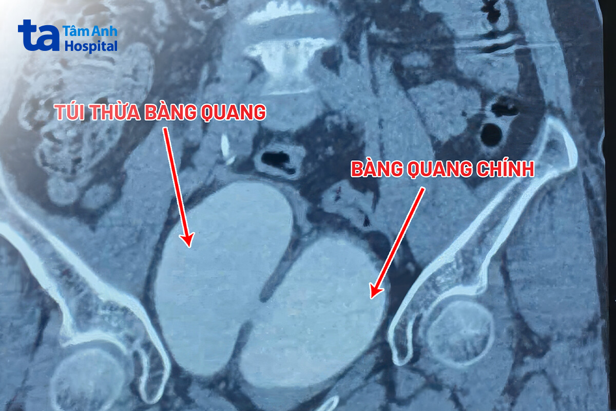 kết quả chụp ct có 2 bàng quang