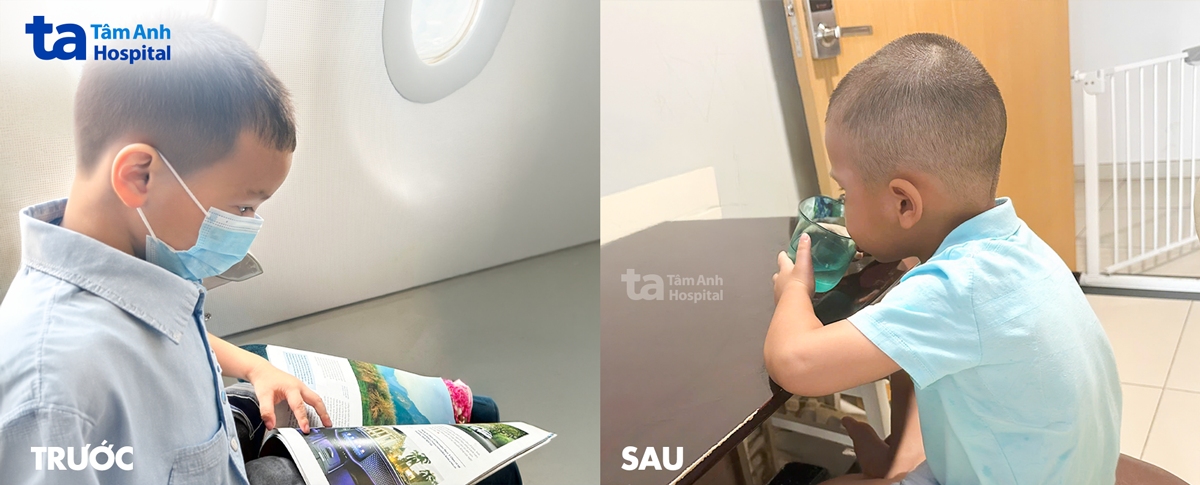 mẫn trước và sau phẫu thuật bàn tay cò súng