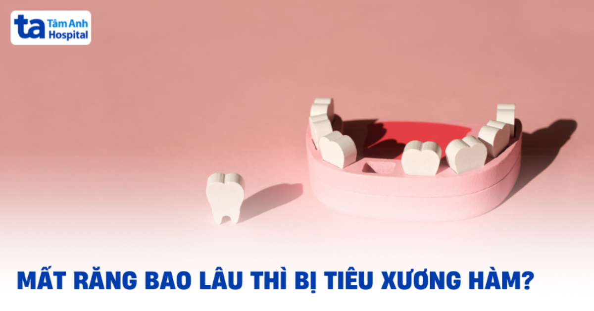 mất răng bao lâu thì bị tiêu xương hàm
