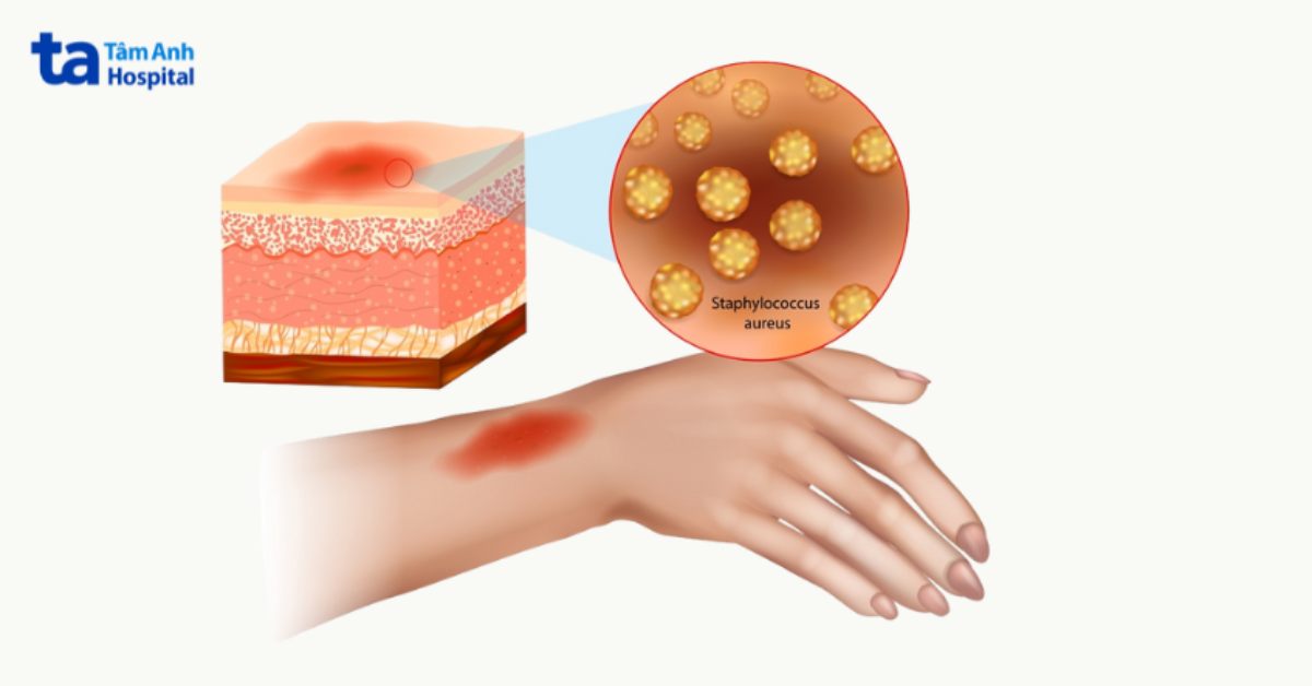minh họa cơ chế gây hội chứng bong vảy do tụ cầu