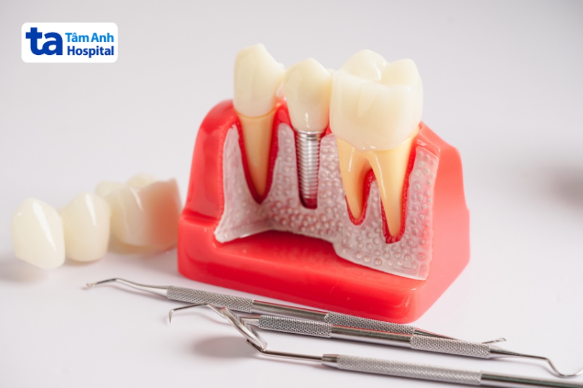 mô hình cấy ghép implant