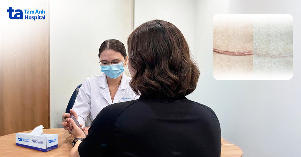 Ngứa dai dẳng do sẹo lồi sau sinh