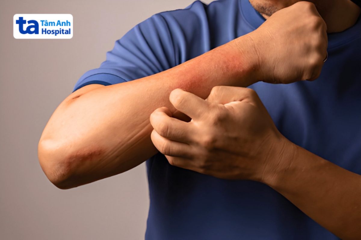 người bệnh gãi nhiều