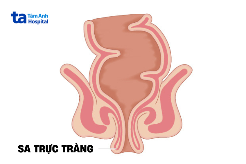 sa trực tràng