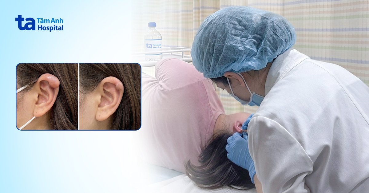 Sai lầm sau xỏ khuyên khiến sẹo lồi nặng hơn