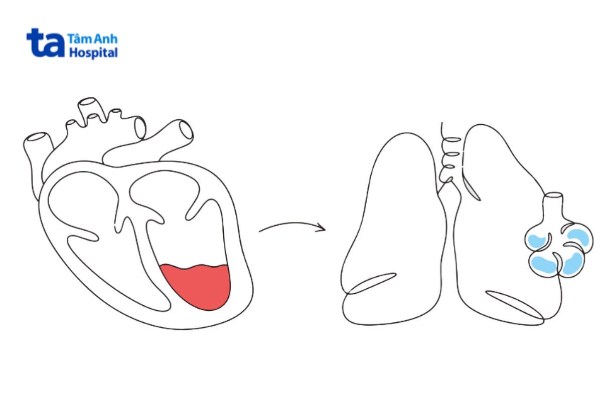 sơ đồ cơ chế phù phổi