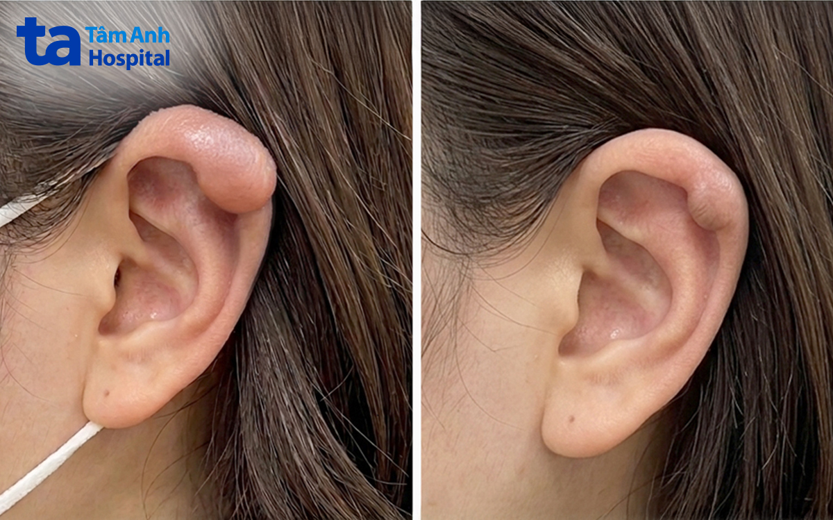 tai bệnh nhân sau 3 lần tiêm thuốc