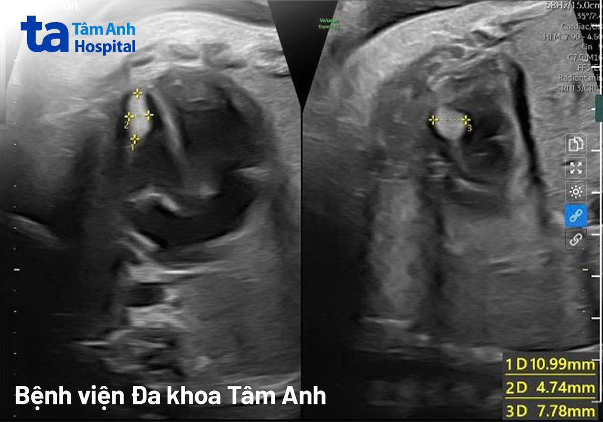 Ảnh siêu âm thai nhi 32tuần với khối u trong cơ thất trái gần mỏm tim. Nguồn: BS Nguyễn Thị Mộng Nghi - Trung tâm Y học bào thai Tâm Anh.