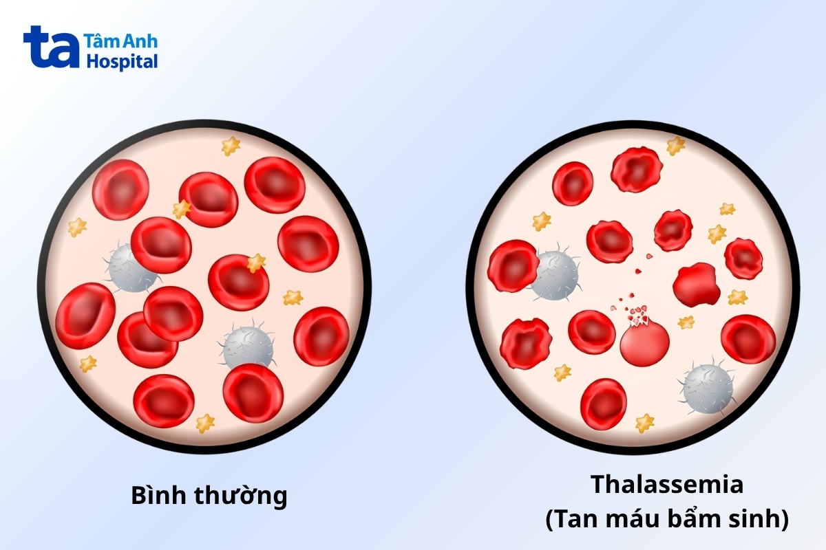 thalassemia tan máu bẩm sinh