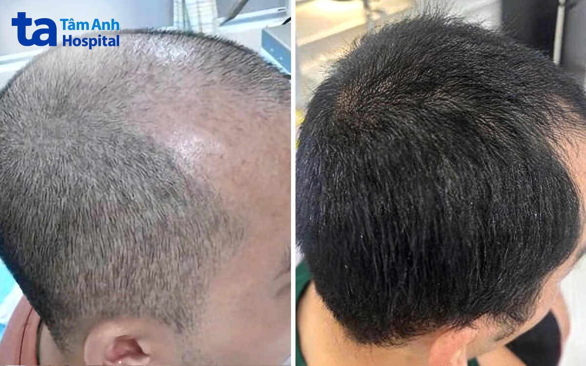 tóc mọc lại sau điều trị
