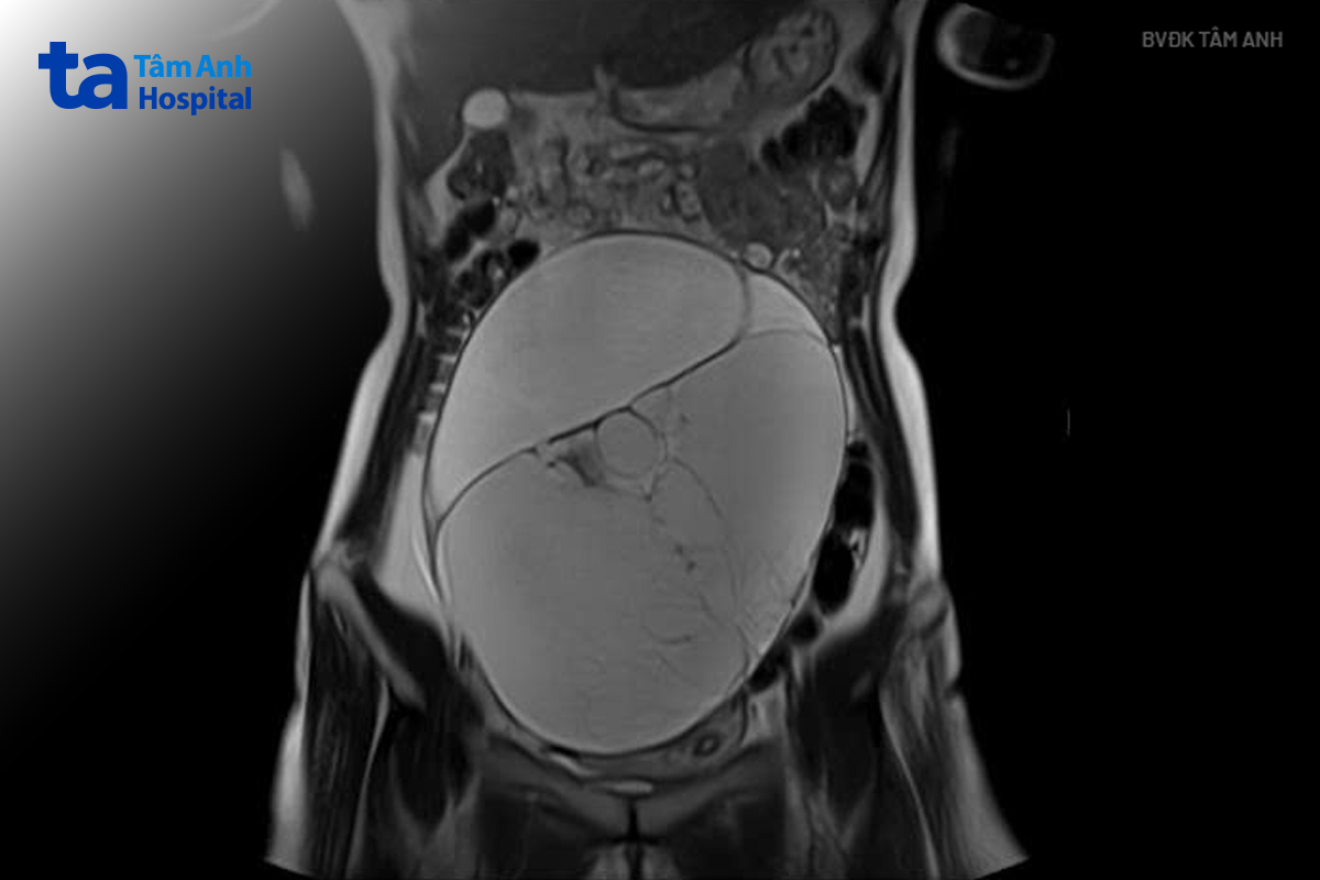 Hình ảnh MRI khối u buồng trứng kích thước lớn, chèn ép nhiều cơ quan trong ổ bụng. Ảnh: Bệnh viện Tâm Anh