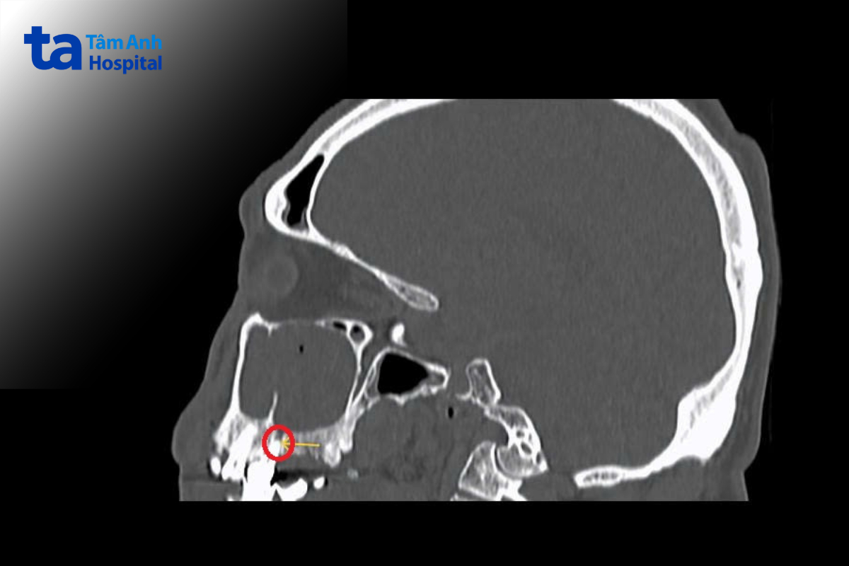 Ổ viêm răng lan lên xoang hàm trên trên CT Scan
