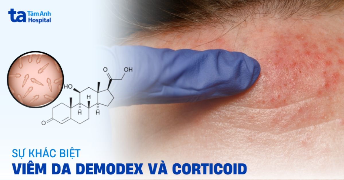 Viêm da demodex và corticoid: Sự khác biệt giữa hai bệnh