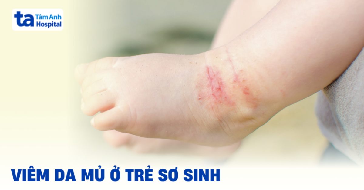 Viêm da mủ ở trẻ sơ sinh: Cha mẹ bé cần lưu ý điều gì?