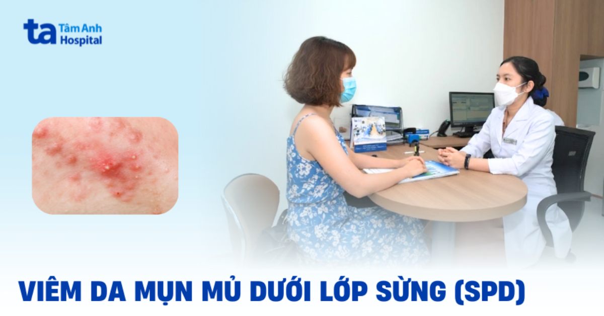 Viêm da mụn mủ dưới lớp sừng (Subcorneal pustular dermatosis)