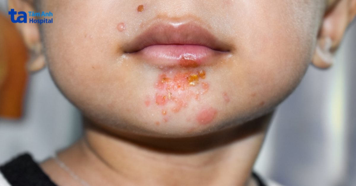 vùng da có mụn bị lở loét