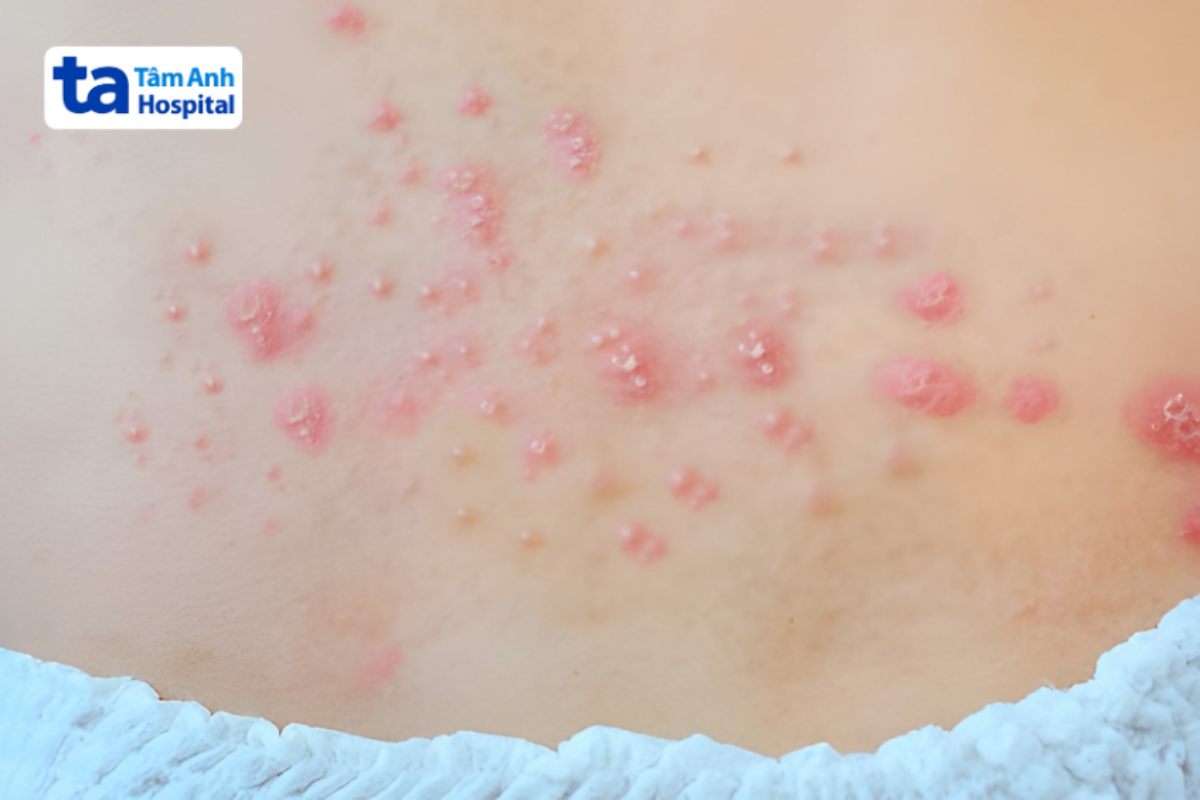vùng da nổi đầy mụn mủ