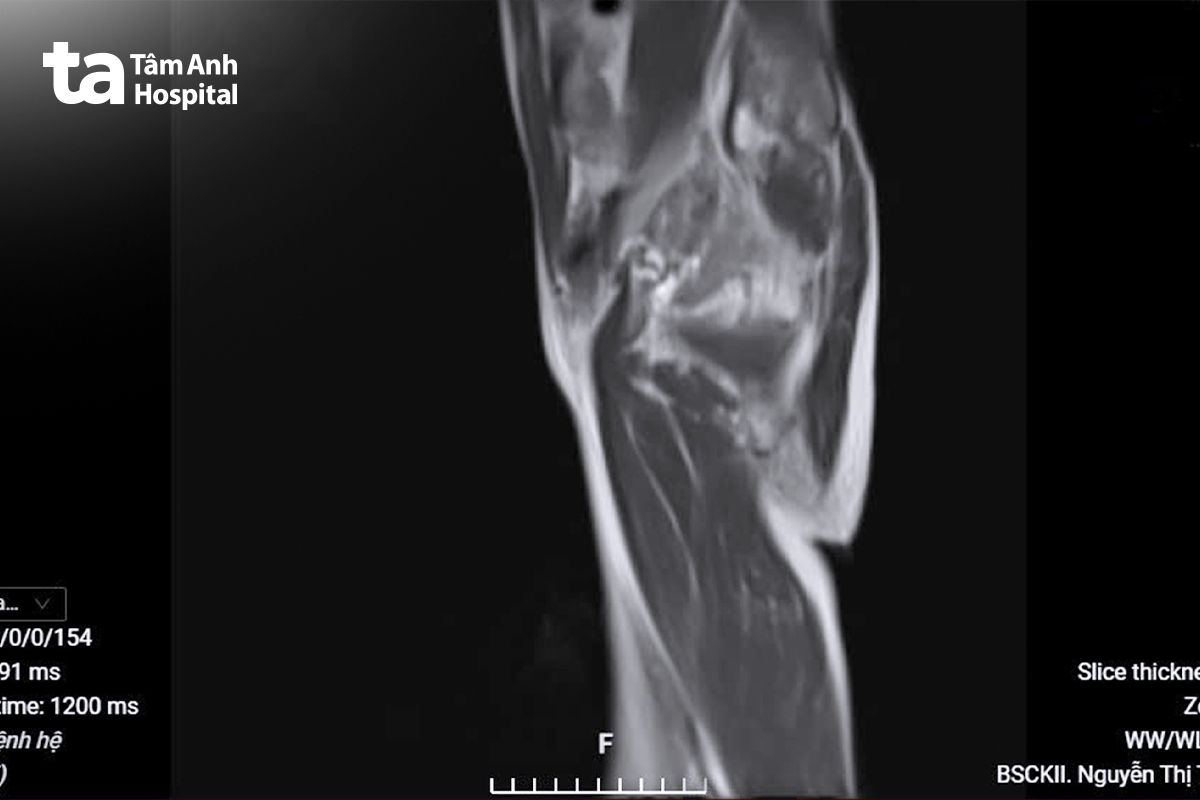 ảnh chụp mri đùi của người bệnh