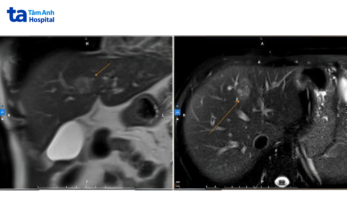 ảnh MRI cho thấy khối u