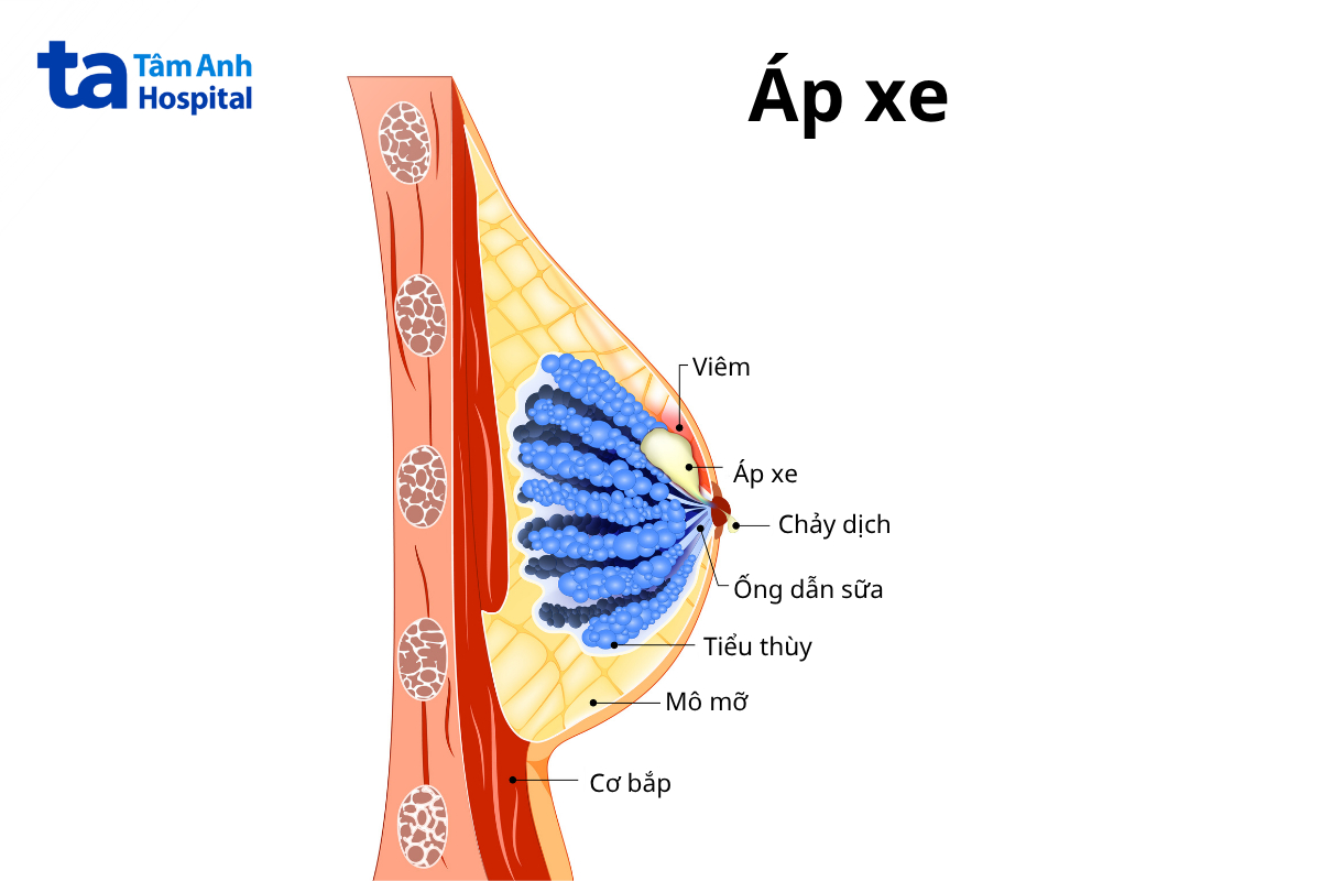 áp xe vú có gây ung thư không
